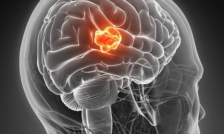 Hallan científicos de Israel un método que detiene la propagación de cáncer mortal en el cerebro